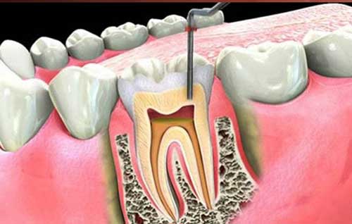 Endodonzia: sconfiggi il mal di denti grazie alla devitalizzazione