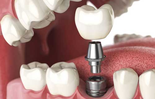 Implantologia dentale 