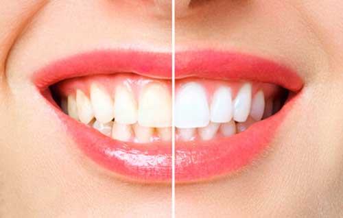 Sbiancamento dentale prima e dopo
