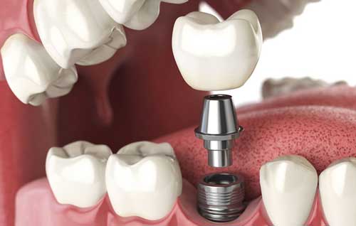 Implantologia Dentale: Innovazione e Ricerca per Sorrisi Radiosi