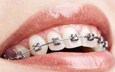Ortodonzia Fissa al Centro Odontoiatrico San Paolo: Innovazione e Estetica