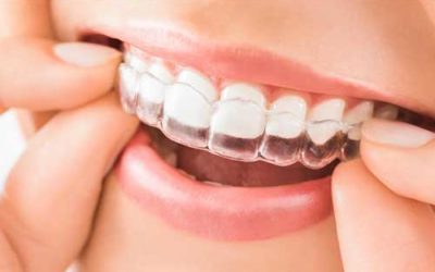Ortodonzia Invisibile: raddrizza i denti “di nascosto”