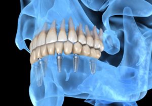 Implantologia Computer Guidata: denti fissi senza tagli e senza punti.