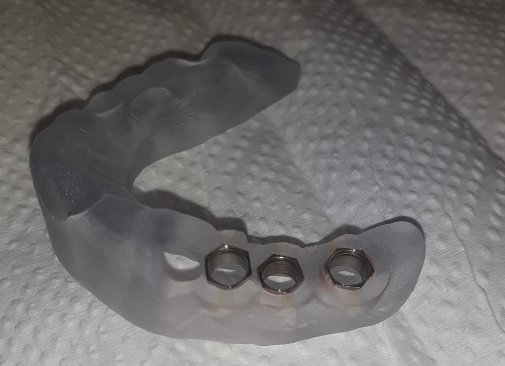 Implantologia Computer Guidata: denti fissi senza tagli e senza punti.
Dima Prodotta

