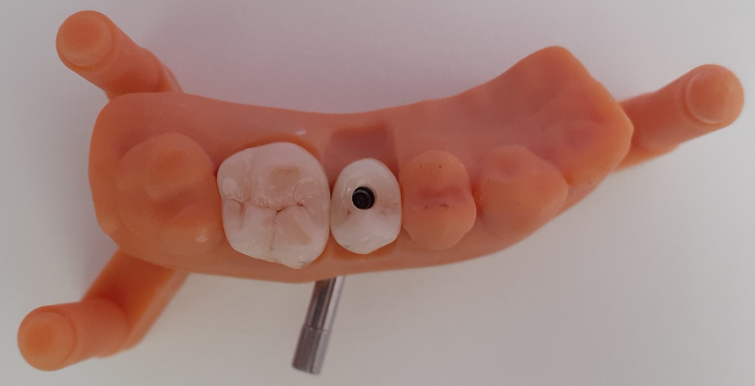 Riabilitazione full-digital di premolare e molare .